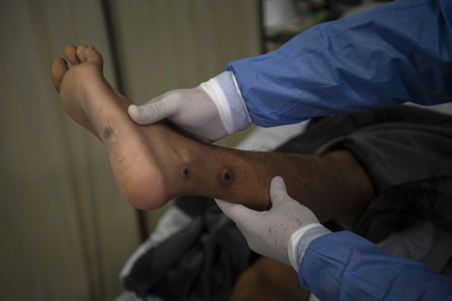 Monkeypox cases top 70,000: WHO